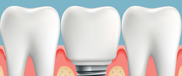 Your Intro to Dental Implants